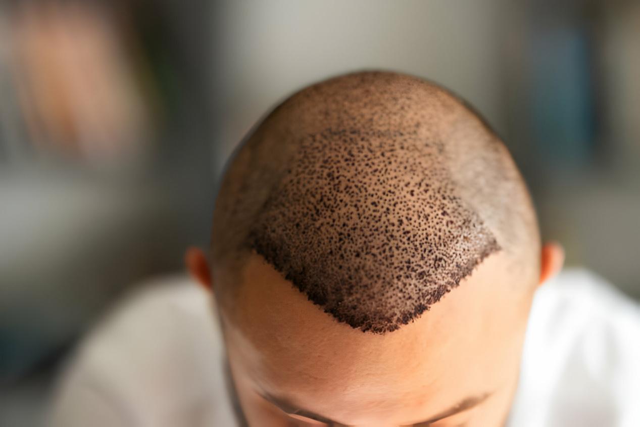 Hair Transplant